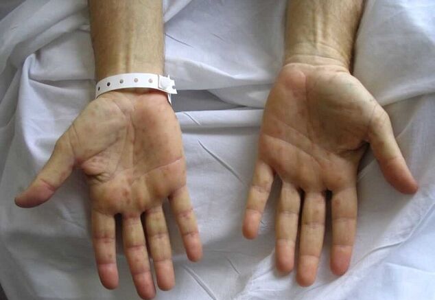 syphilis on the hand as a cause of pathological discharge from the penis
